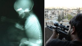 Děsivé foto ze Sýrie: Ostřelovač postřelil těhotnou ženu, její nenarozené dítě trefil přímo do hlavičky