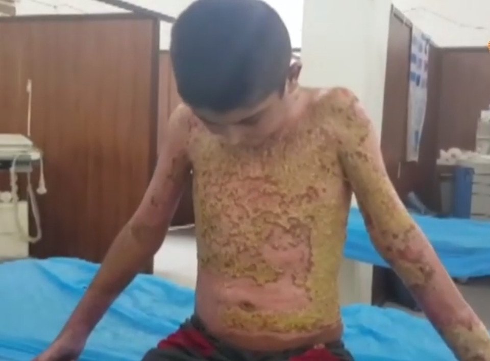 Kurdové obvinili Turecko z používání chemických zbraní. Na snímku chlapec s popáleninami, které podle lékaře způsobil napalm nebo bílý fosfor.