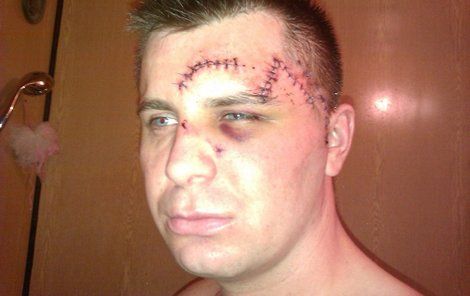 Takhle vypadal Radim Dostál poté, co mu lékaři několik ran sešili.