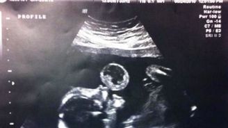Když uviděl gynekolog ultrazvuk, zděsil se! Matka přesto potrat odmítla Když uviděl gynekolog ultrazvuk, zděsil se! Matka přesto potrat odmítla