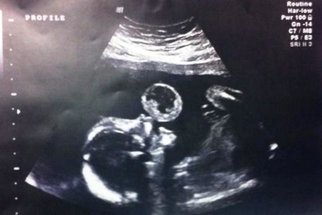Když uviděl gynekolog ultrazvuk, zděsil se! Matka přesto potrat odmítla