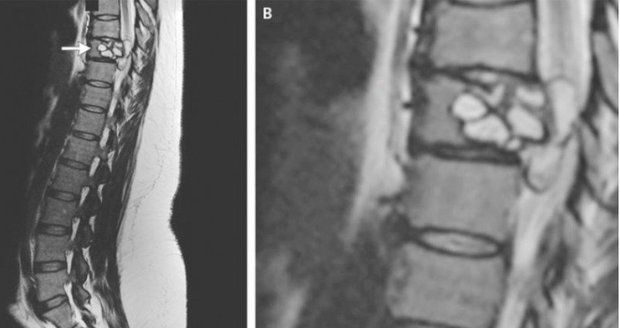 Ženu měsíce bolela záda. Když doktoři zjistili, co má v páteři, byli v šoku