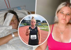 Tayla Clementová (24) z Nového Zélandu trpí takzvaným Moebiůvým syndromem. Kvůli němu se nemůže smát.