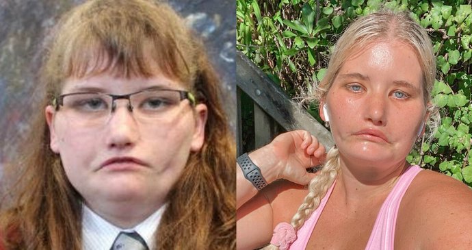 Dívka, která se nemůže smát: Kvůli vzácné nemoci chtěla několikrát spáchat sebevraždu, dnes je z ní modelka