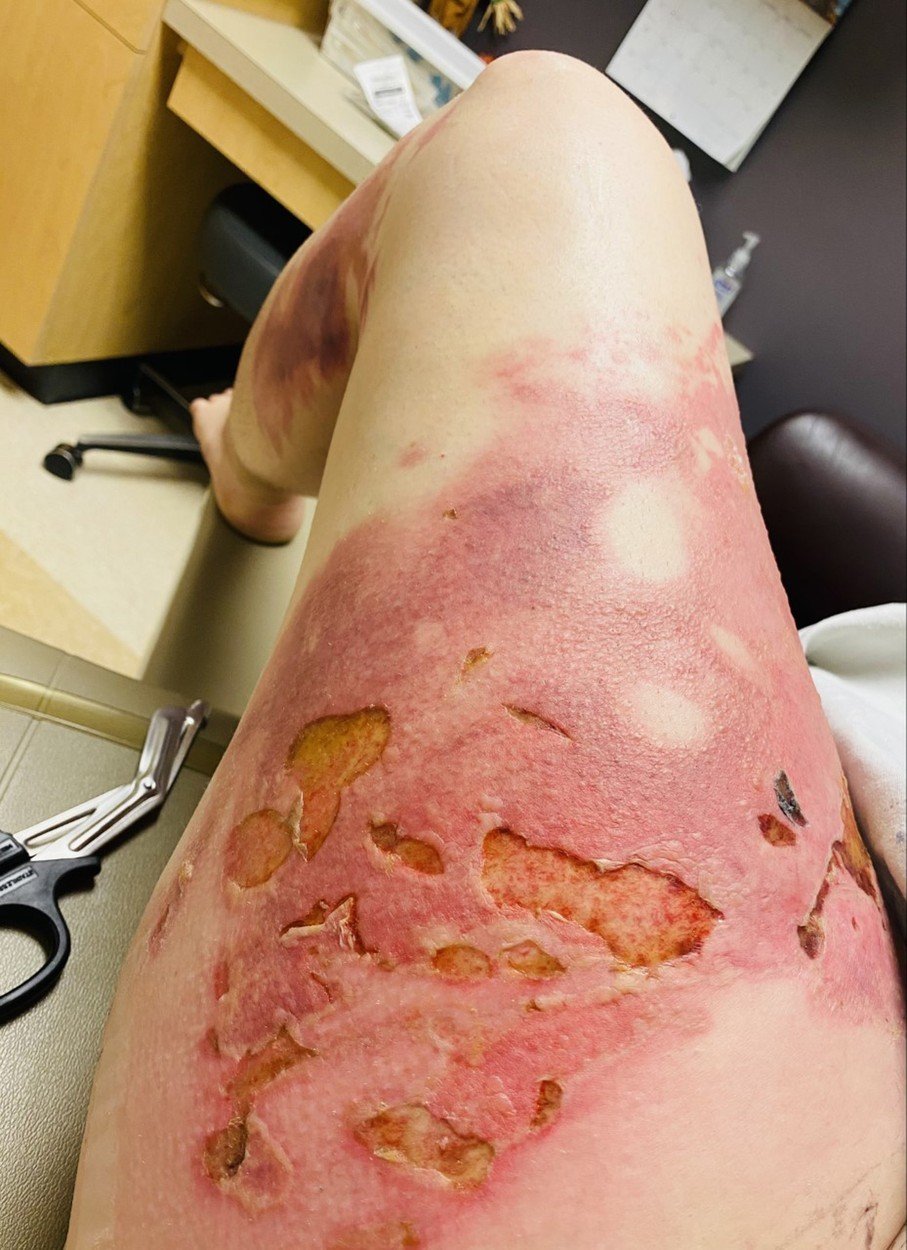 Taylořiny popáleniny se sice hojí, ale nyní bude muset podstoupit náročnou operaci transplantace kůže.