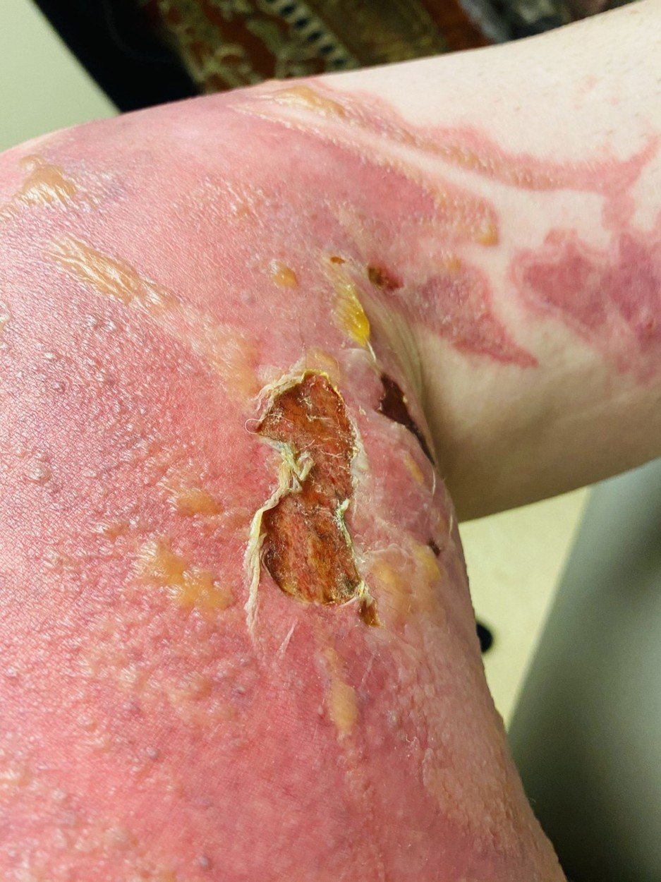 Taylořiny popáleniny se sice hojí, ale nyní bude muset podstoupit náročnou operaci transplantace kůže.