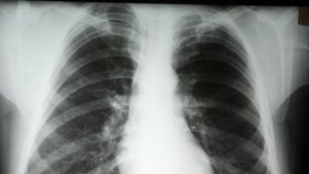 Plíce pacienta nakaženého TBC