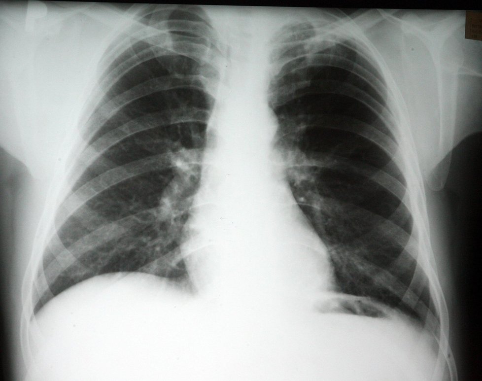 Plíce pacienta nakaženého TBC.