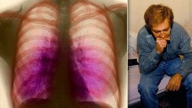 Tuberkulóza zachvátila jižní Moravu: Počet nemocných roste, roznáší ji vězni a zahraniční dělníci