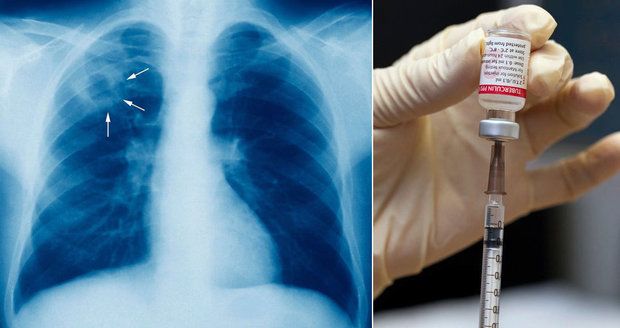 Tuberkulóza se vrací do Česka, nakazilo se dítě. Lékař varuje: Bude hůř