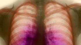 Pacienty s TBC u nás tvoří hlavně cizinci (ilustrační foto)