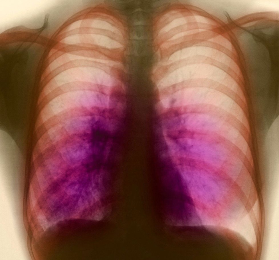 Pacienty s TBC u nás tvoří hlavně cizinci (ilustrační foto)