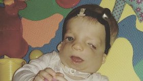 Malá Beátka trpí vzácným Treacher Collinsovým syndromem, stejnou nemocí trpí jen asi 200 lidí v ČR
