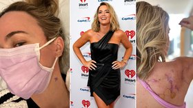Sexy moderátorka bojuje s rakovinou kůže: Ukázala hrozné jizvy i bulku na krku!