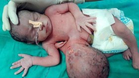 V Indii se narodilo dítě, kterému z břicha vyrůstá nevyvinutý sourozenec.