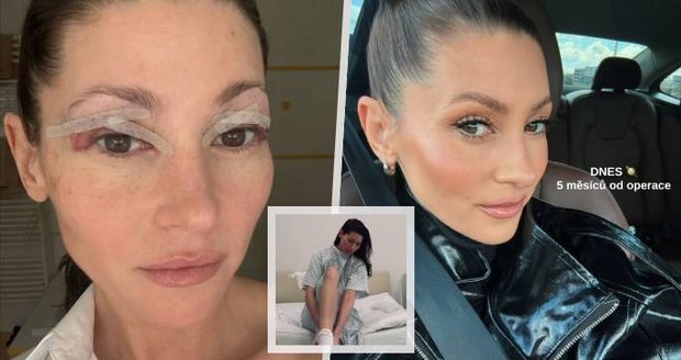 Tereza Kerndlová podstoupila operaci víček!