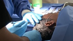 Nešťastnice z americké Louisiany Tessica Brownová si na hlavu aplikovala víceúčelové superlepidlo ve spreji Gorilla místo laku na vlasy. Zbavil jí ho až vyhlášený plastický chirurg.