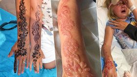 Holčičku (7) zohyzdilo tetování z henny. Rozmar z dovolené se jí zažral do kůže