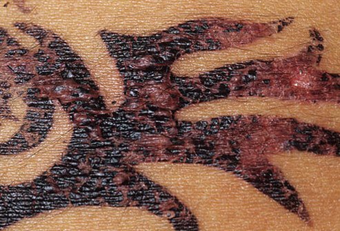 Na černou hennu má mnoho lidí alergii.