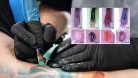 Pigment z tetování se rychle šíří lymfatickým systémem, usadí se v uzlinách a může vyvolat i chronický zánět.