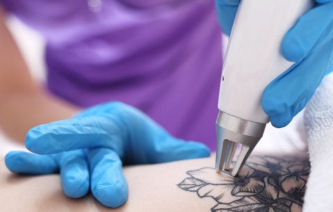 Chystáte se odstranit tetování? Víme, jaké máte možnosti a jestli to bolí