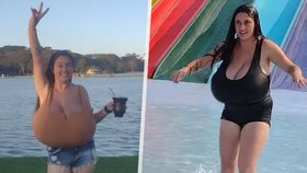 Thaynara Marcondes (22) trpěla extrémní formou vzácného onemocnění zvaného gigantomastie.