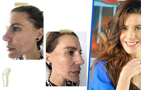 »Potvora« ze Slunečné Monika Timková: Tohle je její tvář bez make-upu! Akné a pigmentové skvrny 