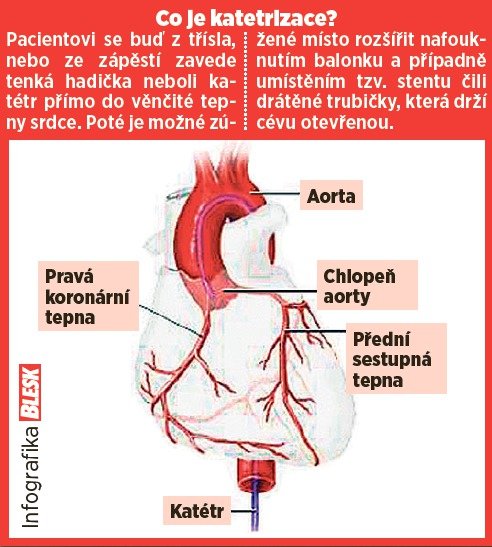 Co je katetrizace?