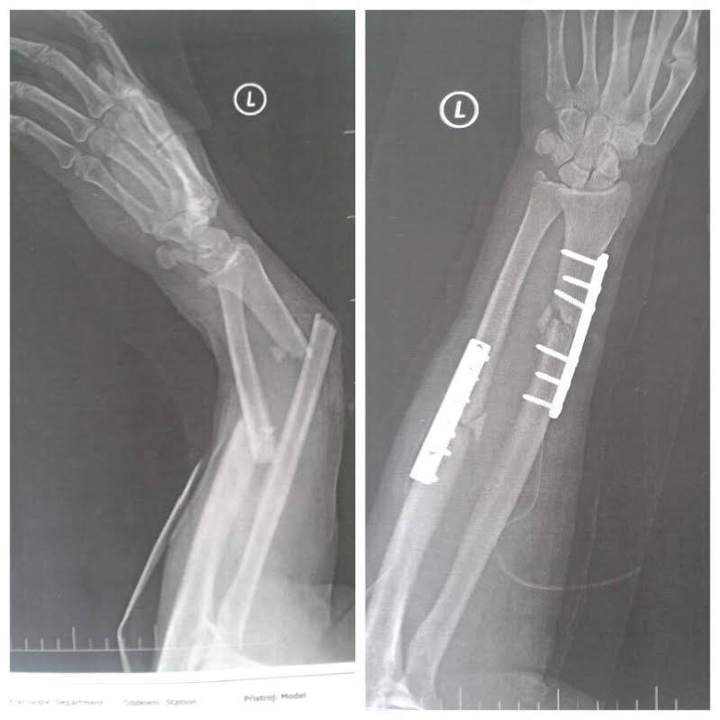 Rentgenové snímky Tomášovy ruky dokazují, jak závažná jsou jeho zranění. Kosti má k sobě spojené železy a šrouby.