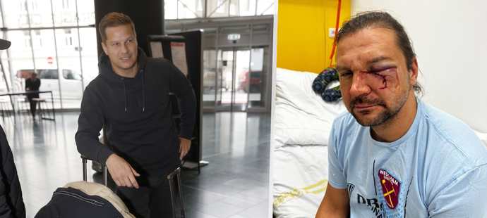 Výsledek napadení se na tváři Václava Pešíra hodně podepsal.