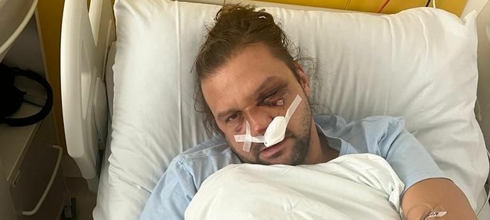 Václav Pešír po dvouhodinové operaci rozbitého obličeje. Zlomeniny lékaři spravili, ale pořád vypadá zle a krvácí z nosu a oka.