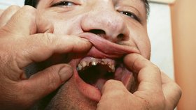 Zuby největšího Čecha by zubařské ošetření potřebovaly už jako sůl