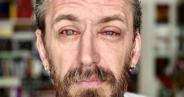 Tomáš Třeštík con inflamación de los ojos Tomáš Třeštík con inflamación de los ojos