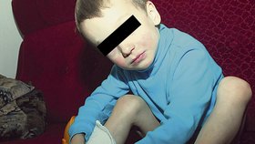 Pětiletý Tomášek si občas škrábe znetvořené nožičky, protože jizvy ho nesnesitelně svědí