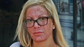 Tori Spelling se zarudlým obličejem. Herečka chodí pravidelně na chemický peeling.