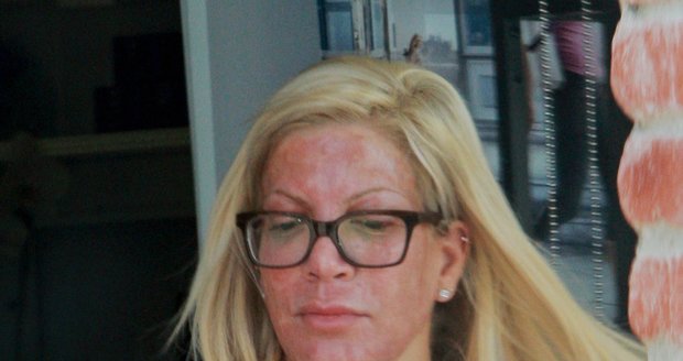 Tori Spelling se zarudlým obličejem. Herečka chodí pravidelně na chemický peeling.