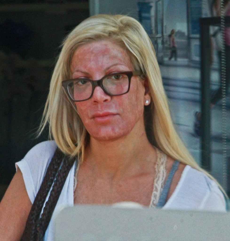 Tori Spelling se zarudlým obličejem. Herečka chodí pravidelně na chemický peeling.