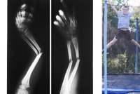 Otevřené zlomeniny, úlomky kostí i doživotní následky: Ortoped z Motola ukázal děsivá zranění z trampolín