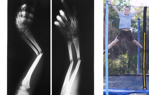 Otevřené zlomeniny, úlomky kostí i doživotní následky: Ortoped z Motola ukázal děsivá zranění z trampolín