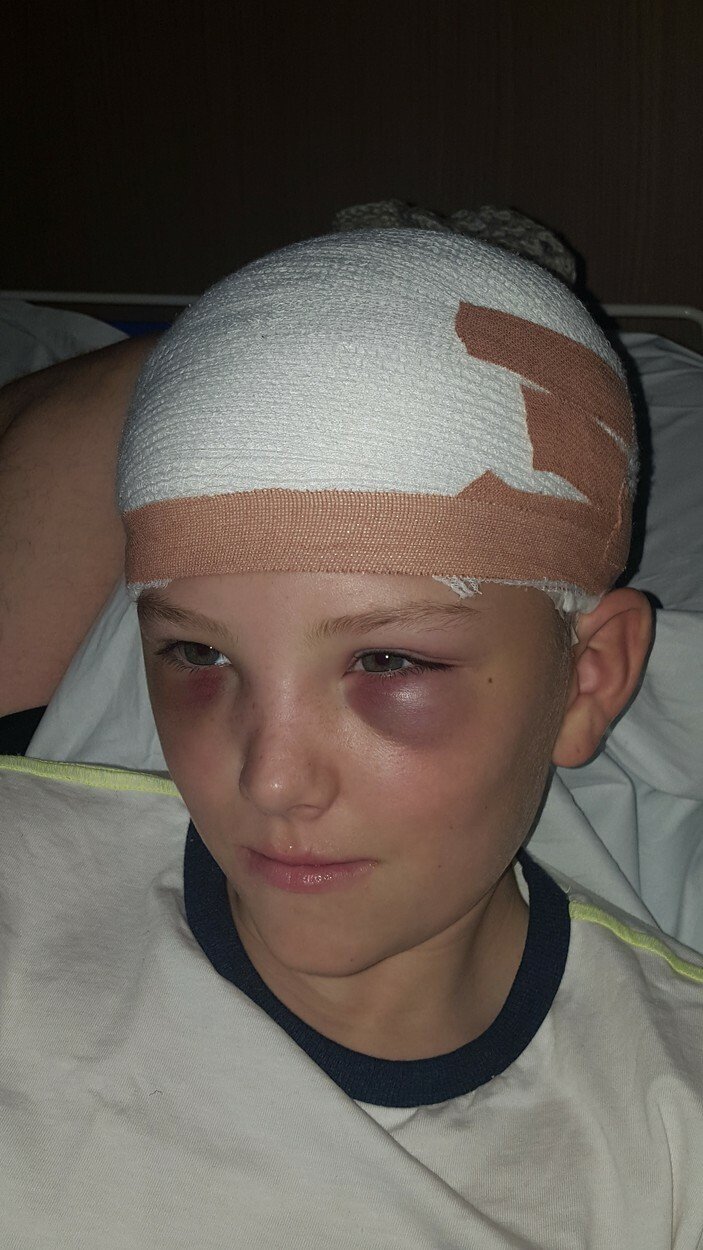 Fotbalista Mikey z Británie si 2016 v trampolínovém centru vážně poranil hlavu a musel nosit ochrannou helmu jako Petr Čech.