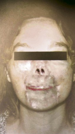 První ženě s transplantovaným obličejem chyběla před zákrokem půlka obličeje. Nyní vypadá téměř normálně.