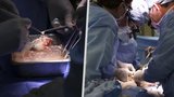 Další milník v medicíně prolomen: Nemocnice v USA oznámila první úspěšnou transplantaci prasečí ledviny člověku! 