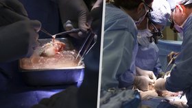 Další milník v medicíně prolomen: Nemocnice v USA oznámila první úspěšnou transplantaci prasečí ledviny člověku! 