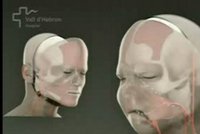 Unikátní operace: Znetvořenému muži vyměnili celý obličej!