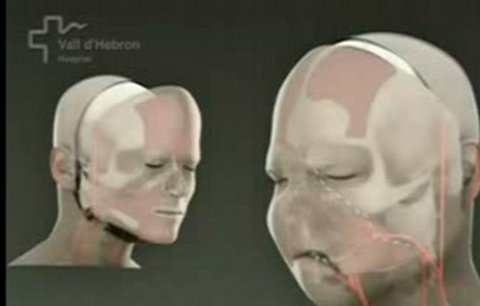 Unikátní operace: Znetvořenému muži vyměnili celý obličej!