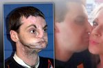 Znetovřený muž našel po transplantaci obličeje lásku.