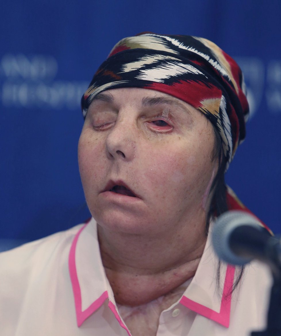 Carmen Tarletonová před druhou transplantací.