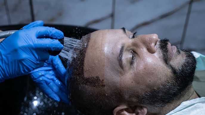 Muž po transplantaci vlasů. Muž po transplantaci vlasů.