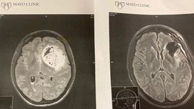 Osobní trenérce na přední levé části mozku nalezli lékaři astrocytom.