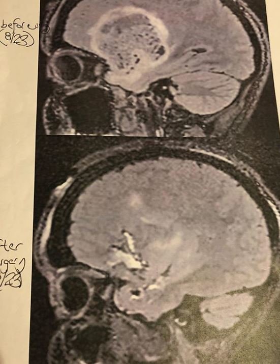 Osobní trenérce na přední levé části mozku nalezli lékaři astrocytom.